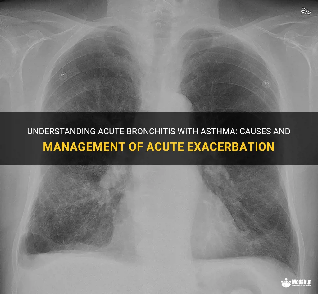 acute bronchitis with asthma with acute exacerbation