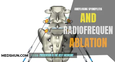 The Potential of Radiofrequency Ablation in Treating Ankylosing Spondylitis
