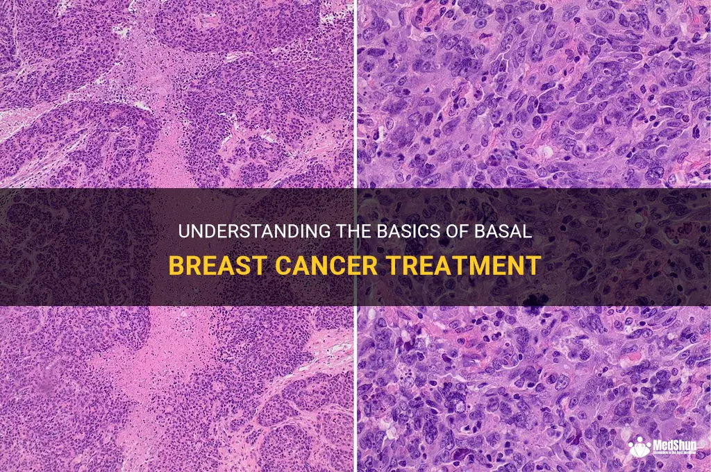 basal breast cancer treatment
