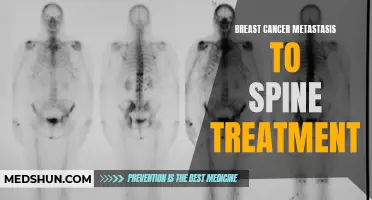 New Advances in the Treatment of Breast Cancer Metastasis to the Spine: Are There Any Promising Therapies?