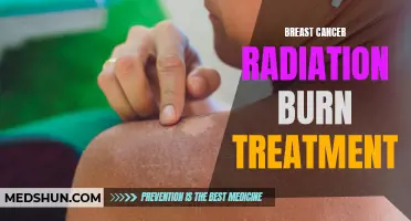 The Importance of Proper Treatment for Breast Cancer Radiation Burns