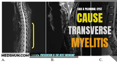 The Link Between Pilonidal Cysts and Transverse Myelitis: Understanding the Connection