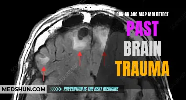 Unveiling the Mystery: Can an MRI Detect Past Brain Trauma in ADC Mapping?