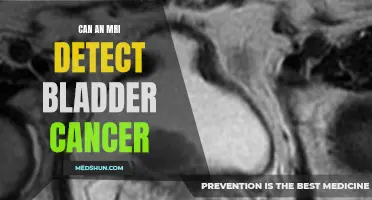 Understanding How an MRI Can Detect Bladder Cancer
