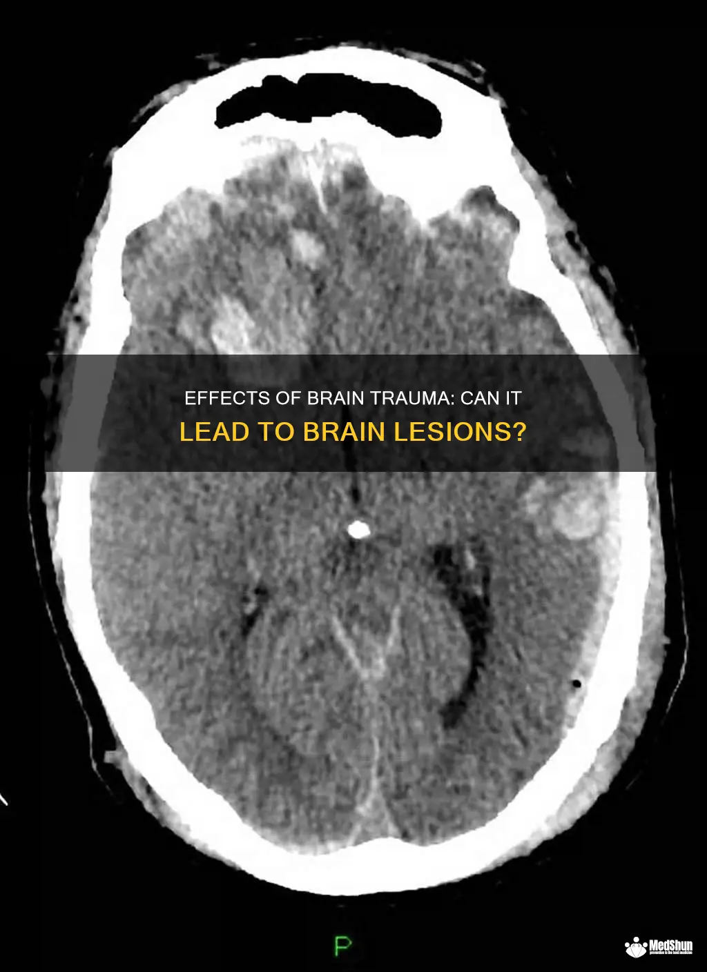 Effects Of Brain Trauma: Can It Lead To Brain Lesions? | MedShun