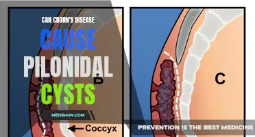 Understanding the Relationship between Crohn's Disease and Pilonidal Cysts: Exploring the Possible Connection