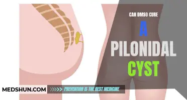 Can DMSO Cure a Pilonidal Cyst? An Investigation into the Potential Benefits of DMSO for Treating Pilonidal Cysts