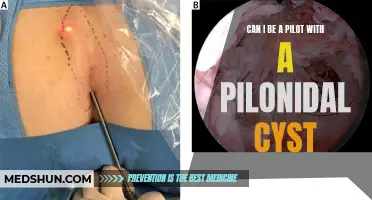 Is a Pilonidal Cyst a Disqualifier for Becoming a Pilot?