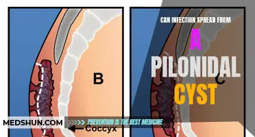 Exploring the Contagiousness of Pilonidal Cysts: Can Infection Spread?