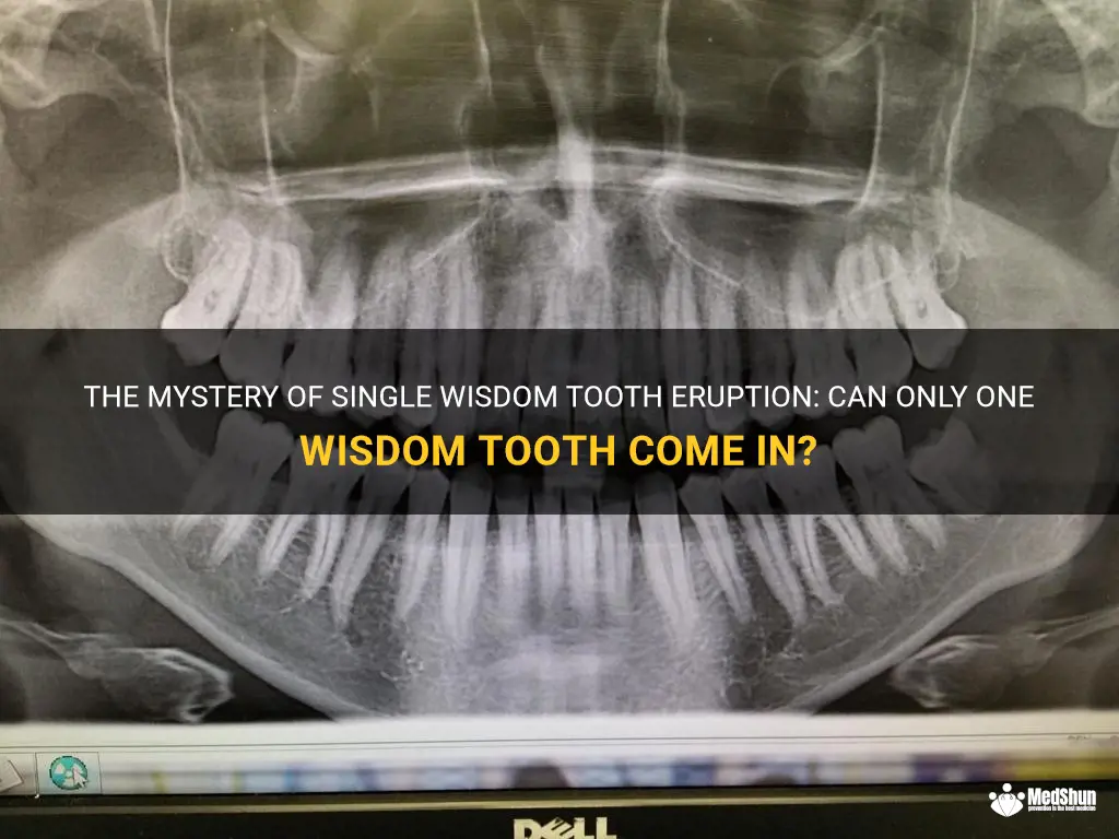 The Mystery Of Single Wisdom Tooth Eruption: Can Only One Wisdom Tooth ...