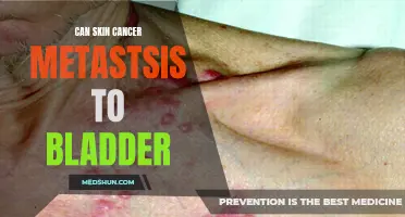 Understanding the Risk: Can Skin Cancer Metastasize to the Bladder?