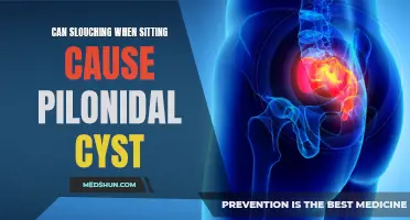 The Impact of Slouching When Sitting on Pilonidal Cysts