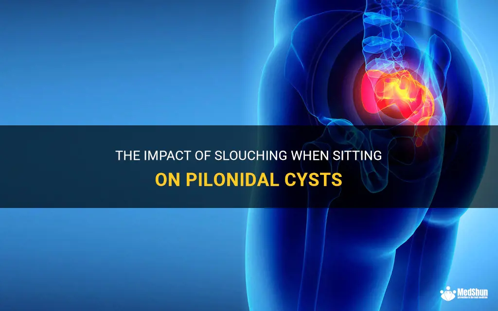 can slouching when sitting cause pilonidal cyst