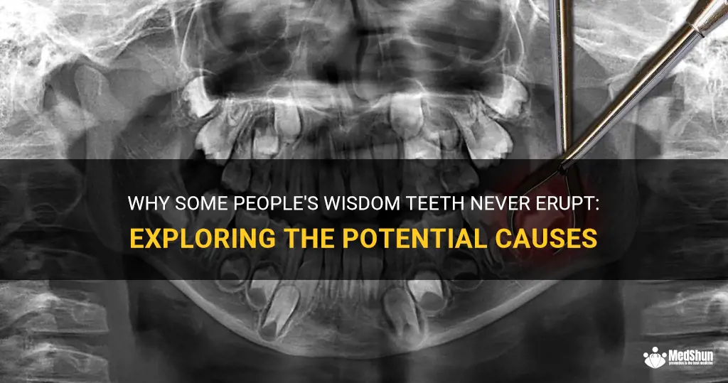 Why Some People's Wisdom Teeth Never Erupt: Exploring The Potential ...