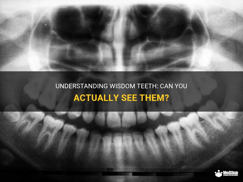 Understanding Wisdom Teeth: Can You Actually See Them? | MedShun