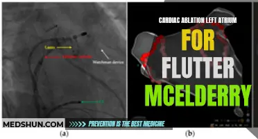 Understanding the Use of Cardiac Ablation in the Left Atrium for Treating Flutter: The McElderry Approach