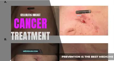 The Connection Between Cellulitis and Breast Cancer Treatment