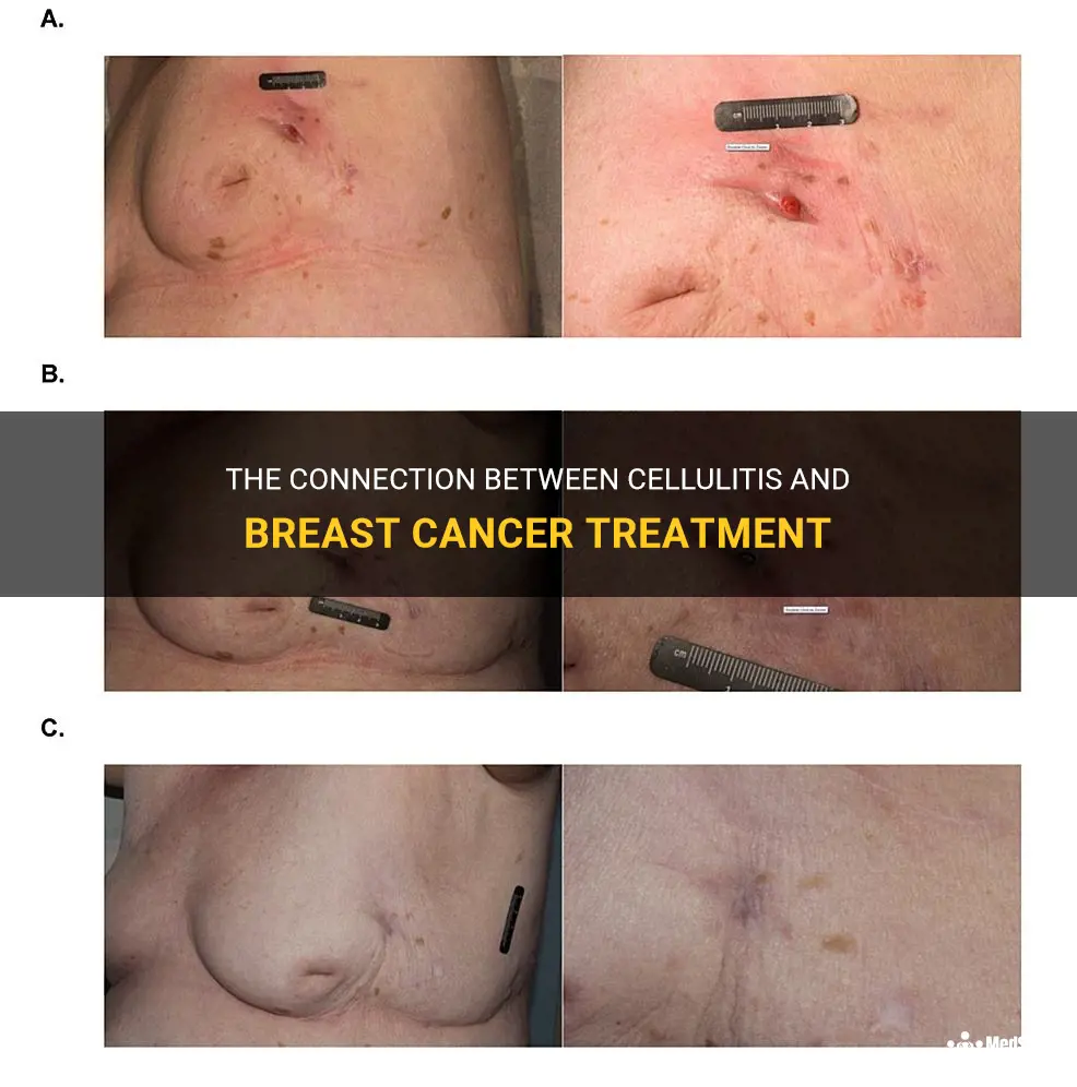 cellulitis breast cancer treatment