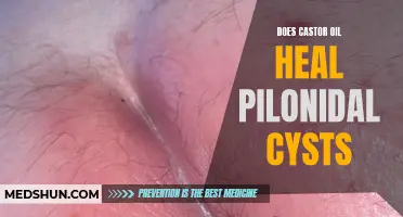 Can Castor Oil Heal Pilonidal Cysts?