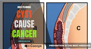 Pilonidal Cyst: Exploring the Link with Cancer