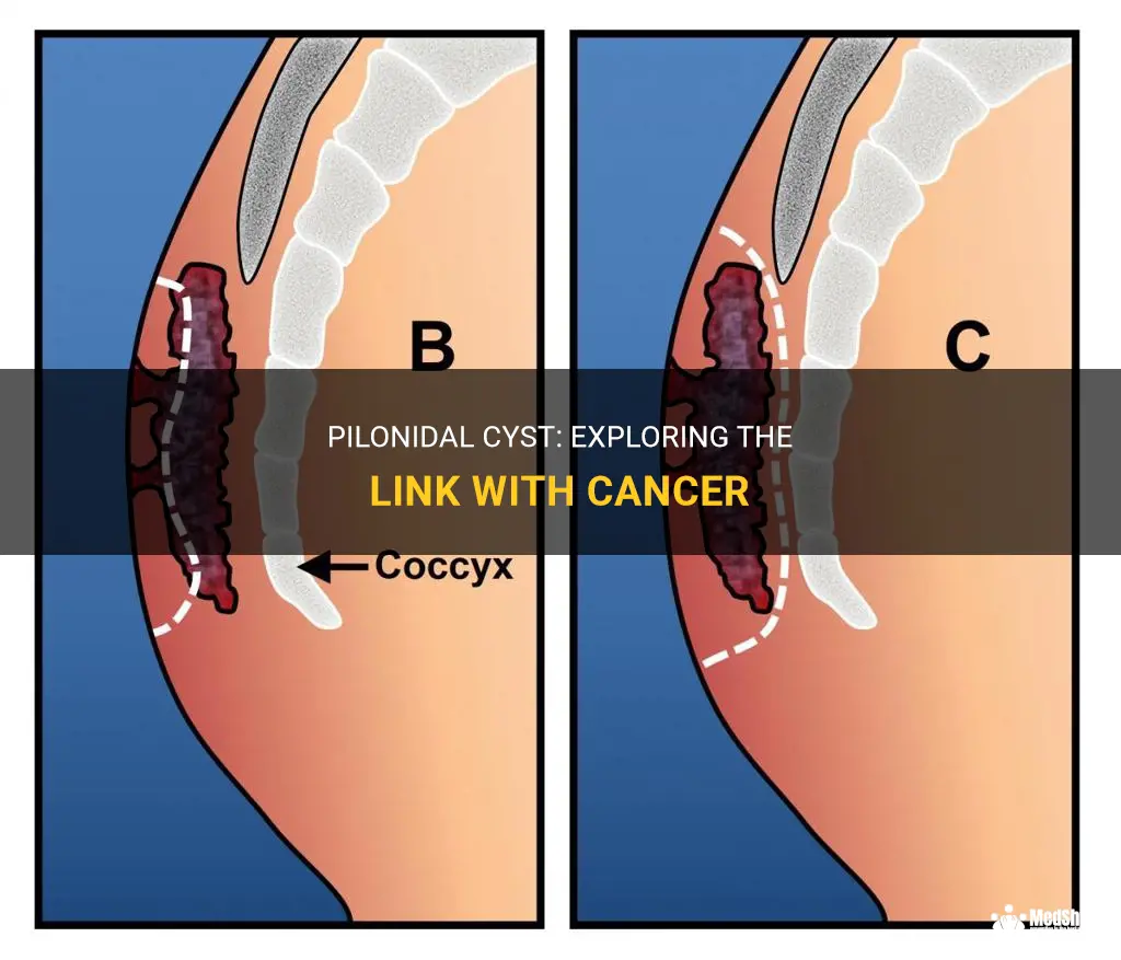 does pilonidal cyst cause cancer