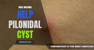 The Impact of Walking on Pilonidal Cysts: Is it Beneficial?