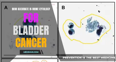Is Urine Cytology a Reliable Diagnostic Tool for Bladder Cancer?