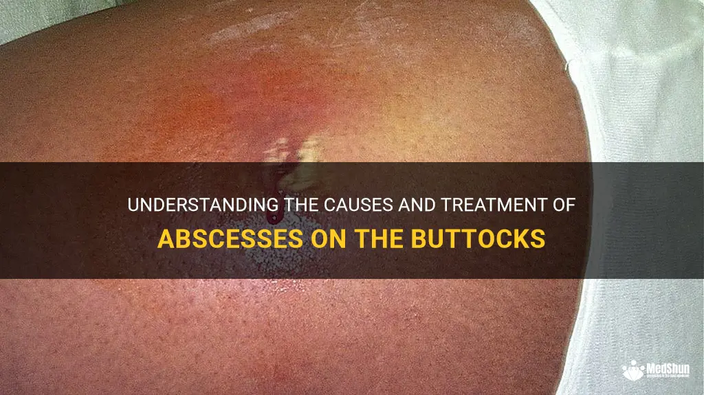 how do you get an abscess on your buttocks