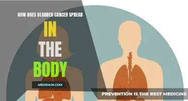 Understanding the Spread of Bladder Cancer in the Body: A Comprehensive Guide