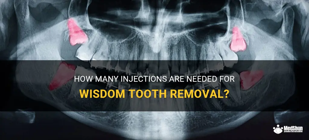 How Many Injections Are Needed For Wisdom Tooth Removal? | MedShun