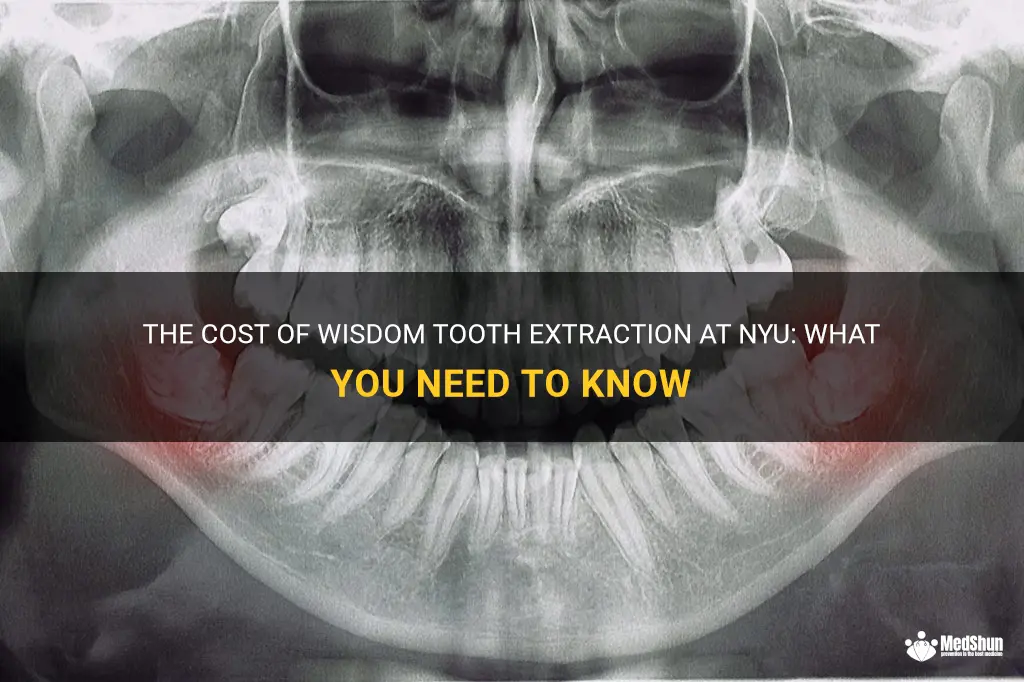 The Cost Of Wisdom Tooth Extraction At Nyu: What You Need To Know | MedShun