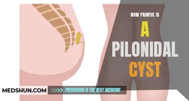 The Agony of Dealing with a Pilonidal Cyst: Understanding the Pain