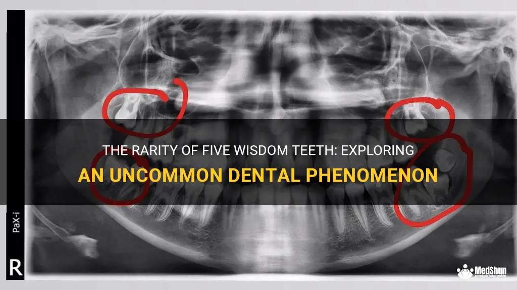 The Rarity Of Five Wisdom Teeth: Exploring An Uncommon Dental ...