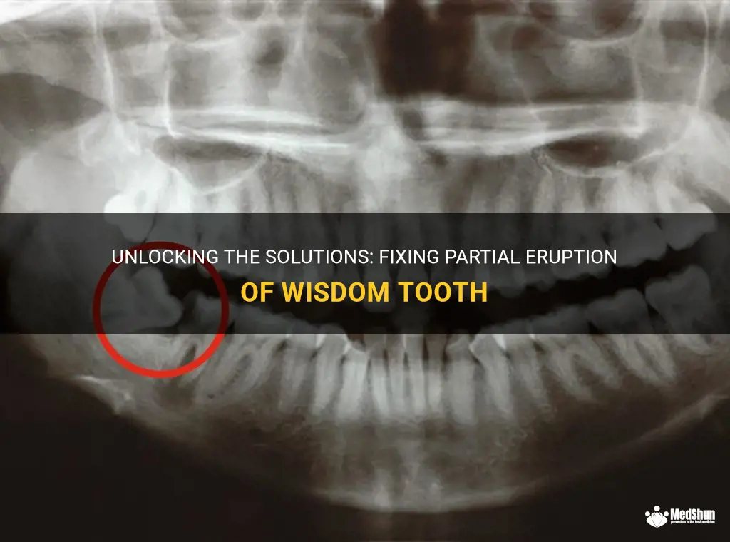 Unlocking The Solutions: Fixing Partial Eruption Of Wisdom Tooth | MedShun
