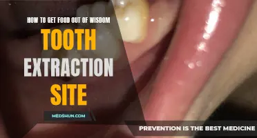 Tips for Removing Food from a Wisdom Tooth Extraction Site