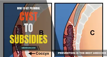 Ways to Alleviate Pilonidal Cyst Symptoms and Promote Subsidies