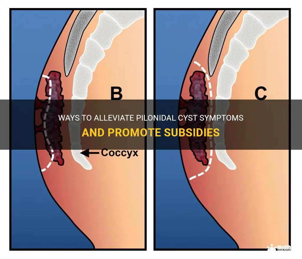 how to get pilonidal cyst to subsidies