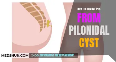 Effective Ways to Remove Pus from a Pilonidal Cyst