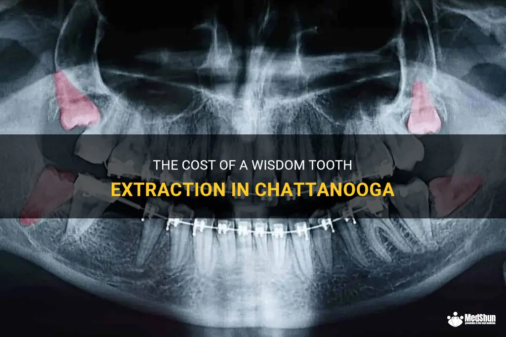 The Cost Of A Wisdom Tooth Extraction In Chattanooga | MedShun