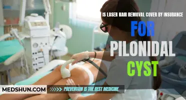 Is Laser Hair Removal Covered by Insurance for Pilonidal Cyst Treatment?