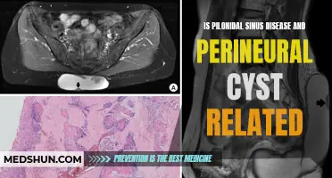 The Connection Between Pilonidal Sinus Disease and Perineural Cyst Revealed