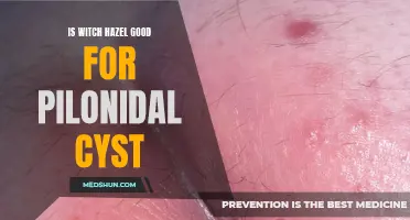Is Witch Hazel Effective for Soothing Pilonidal Cyst Symptoms?