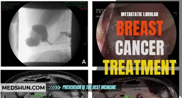 The Latest Advances in Metastatic Lobular Breast Cancer Treatment