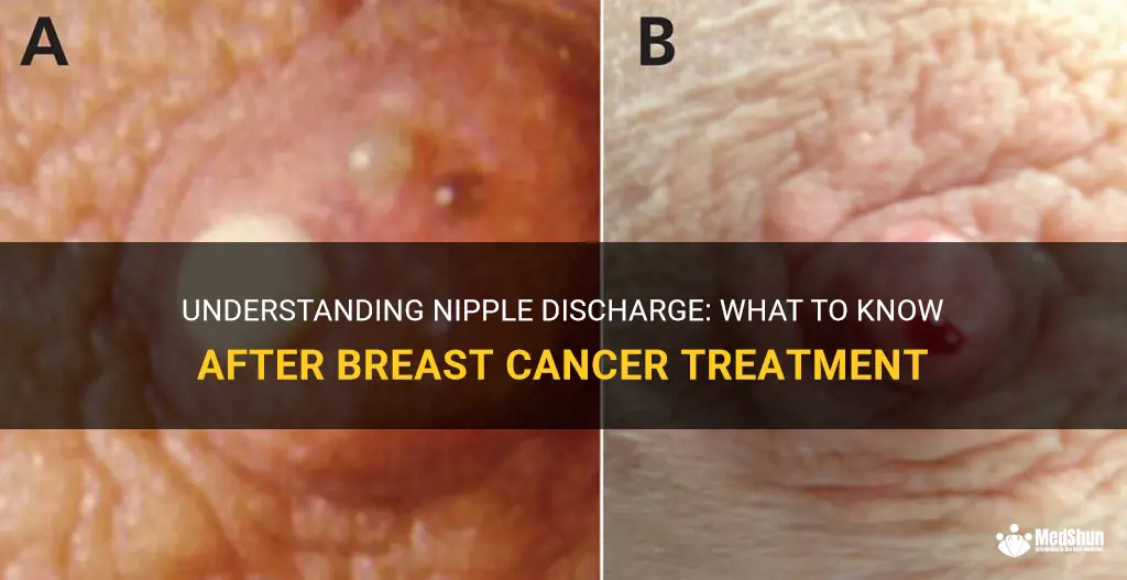nipple discharge after breast cancer treatment