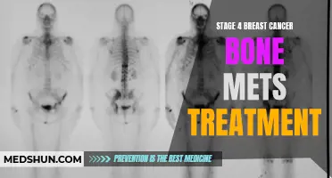 The Latest Advances in Stage 4 Breast Cancer Bone Mets Treatment