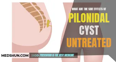 The Potential Consequences of Untreated Pilonidal Cysts