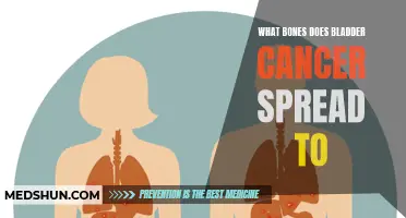 A Comprehensive Guide to the Bones Often Affected by Bladder Cancer Spread