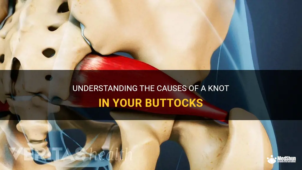 what causes a knot in your buttocks