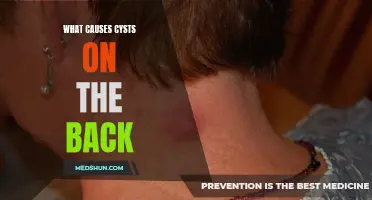 Understanding the Common Causes of Cysts on the Back