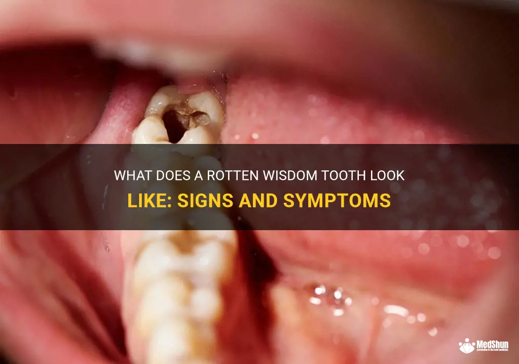 what does a rotten wisdom tooth look like